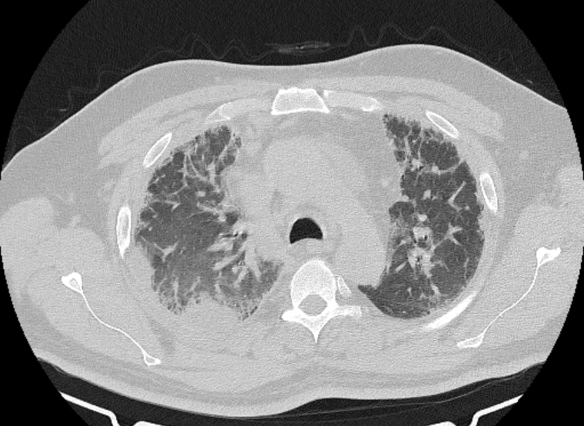 Cardiogenic pulmonary edema (Radiopaedia 68180-77678 Axial lung window 26).jpg