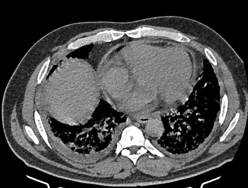Cardiogenic pulmonary edema (Radiopaedia 68180-77678 Axial non-contrast 33).jpg