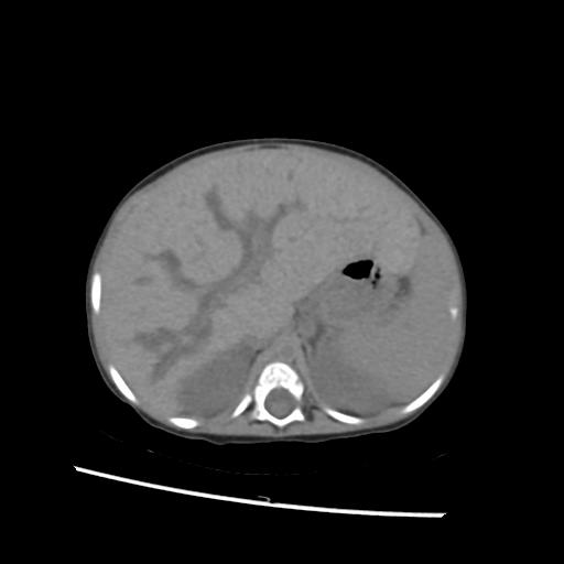File:Caroli disease with autosomal recessive polycystic kidney disease (ARPKD) (Radiopaedia 89651-106703 Axial non-contrast 15).jpg