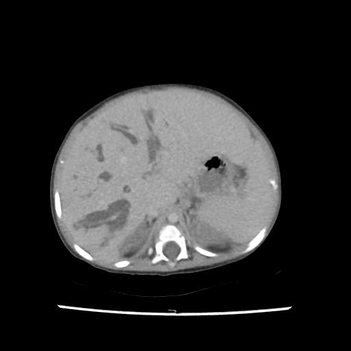 File:Caroli disease with autosomal recessive polycystic kidney disease (ARPKD) (Radiopaedia 89651-106703 B 52).jpg