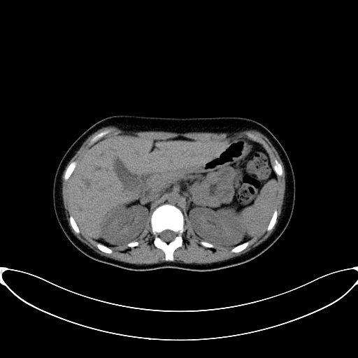 Caroli disease with medullary sponge kidney (Radiopaedia 82622-96804 Axial non-contrast 24).jpg