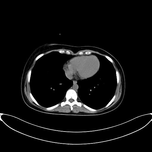 Caroli disease with medullary sponge kidney (Radiopaedia 82622-96804 Axial non-contrast 6).jpg