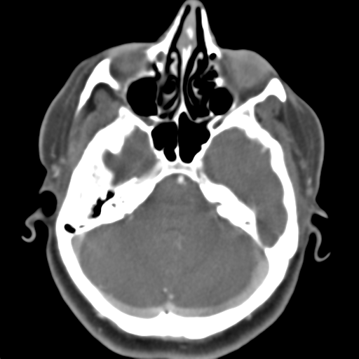 File:Carotico ophthalmic aneurysm (Radiopaedia 42916-46148 A 40).png