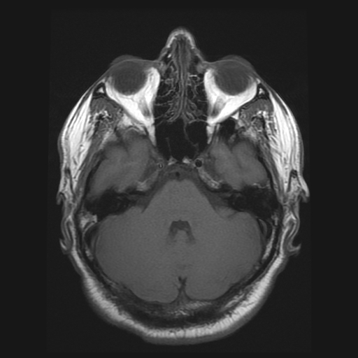 File:Carotid arterial dissection with acute cerebral infarction (Radiopaedia 26636-26784 Axial T1 6).jpg