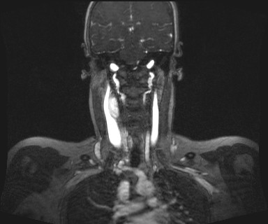 File:Carotid body tumor (Radiopaedia 12777-12912 MRA 40).jpg