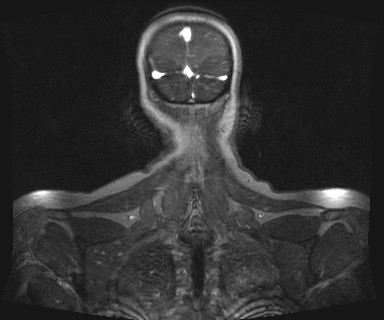 Carotid body tumor (Radiopaedia 12777-12912 MRA 75).jpg