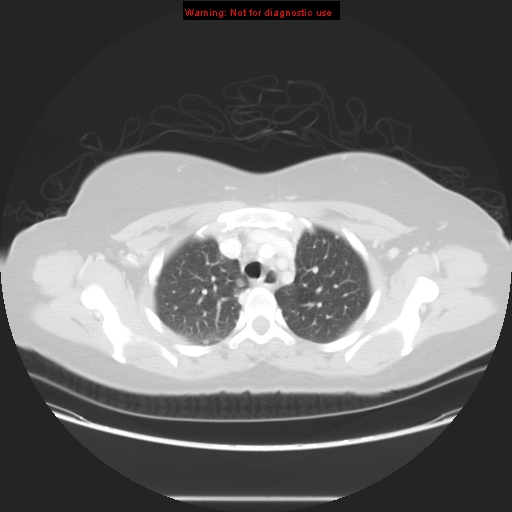 Carotid body tumor with lung metastases (Radiopaedia 9301-48390 Axial lung window 21).jpg