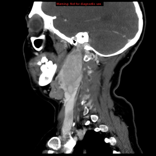 Carotid body tumor with lung metastases (Radiopaedia 9301-9986 Sagittal C+ delayed 37).jpg