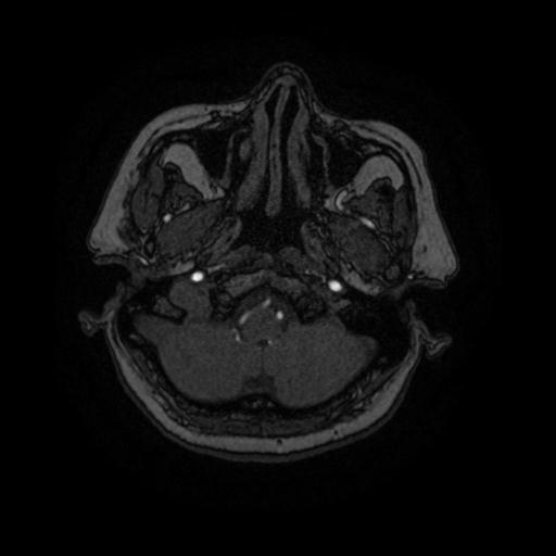 Cavernoma with developmental venous anomaly (Radiopaedia 22470-22507 MRA 89).jpg