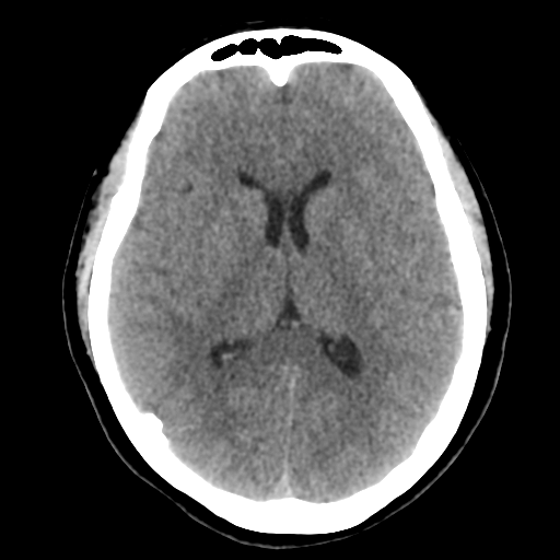 Cavernoma with hemorrhage (Radiopaedia 70755-80931 Axial non-contrast 29).png