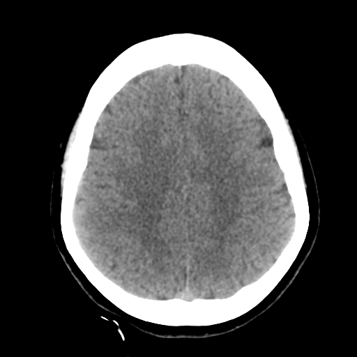 Cavernoma with hemorrhage (Radiopaedia 70755-80931 Axial non-contrast 38).png