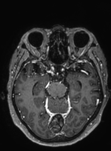 Cavernous hemangioma of the cerebellar falx (Radiopaedia 73025-83724 Axial T1 C+ 210).jpg