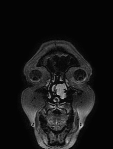 Cavernous hemangioma of the cerebellar falx (Radiopaedia 73025-83724 Coronal FLAIR 3).jpg