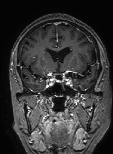 Cavernous hemangioma of the cerebellar falx (Radiopaedia 73025-83724 Coronal T1 C+ 142).jpg