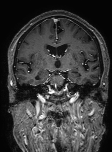 Cavernous hemangioma of the cerebellar falx (Radiopaedia 73025-83724 Coronal T1 C+ 184).jpg