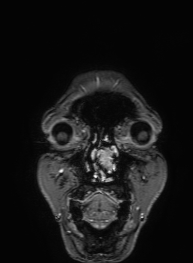 Cavernous hemangioma of the cerebellar falx (Radiopaedia 73025-83724 Coronal T1 C+ 20).jpg