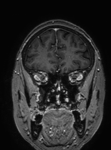 Cavernous hemangioma of the cerebellar falx (Radiopaedia 73025-83724 Coronal T1 C+ 92).jpg