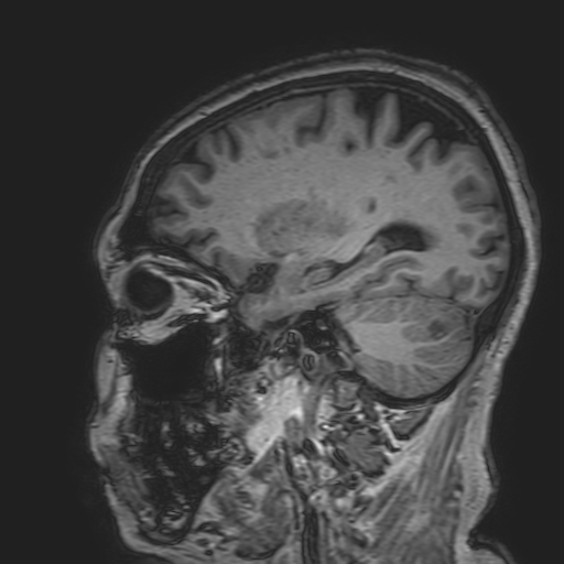 File:Cavernous hemangioma of the cerebellar falx (Radiopaedia 73025-83724 Sagittal T1 68).jpg