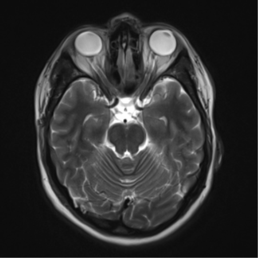 File:Cavernous malformation (cavernous angioma or cavernoma) (Radiopaedia 36675-38237 Axial T2 7).png