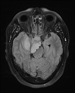 File:Cavernous sinus meningioma (Radiopaedia 63682-72367 Axial FLAIR 9).jpg