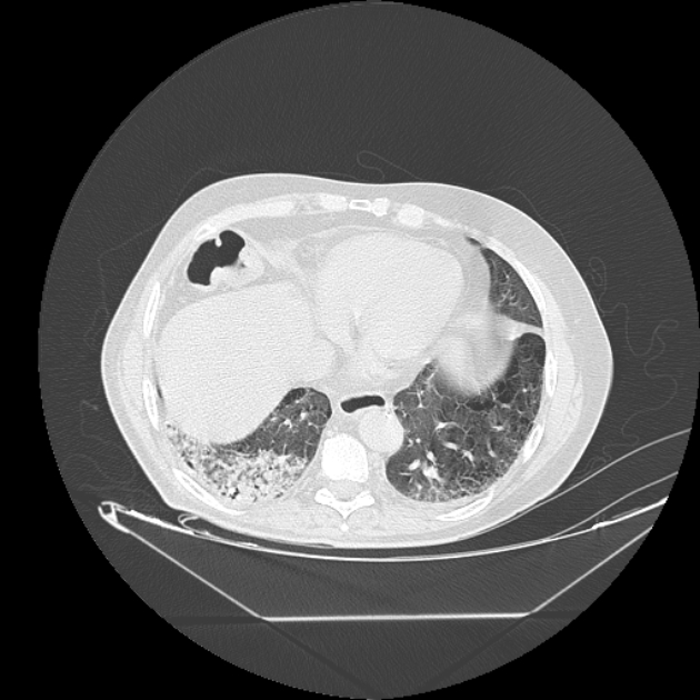 Cavitating bronchogenic carcinoma (Radiopaedia 44489-48162 Axial lung window 63).jpg