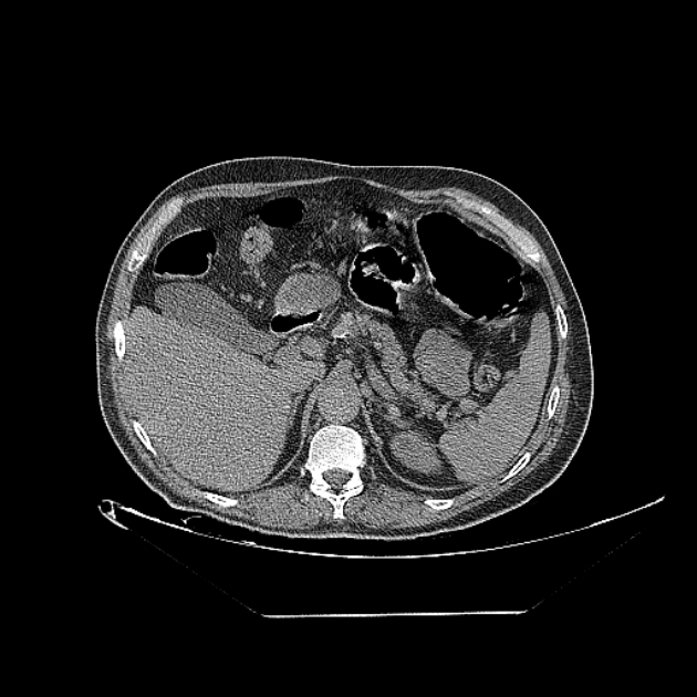 Cavitating bronchogenic carcinoma (Radiopaedia 44489-48162 Axial non-contrast 89).jpg