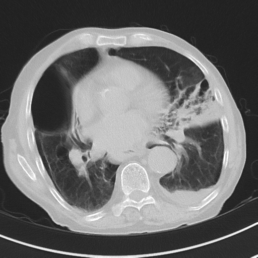 Cavitating pneumonia - lingular segments (Radiopaedia 34386-35678 Axial lung window 36).png