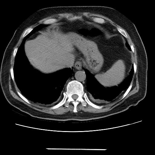 Cavitating pulmonary metastases (Radiopaedia 89545-106544 Axial non-contrast 46).jpg