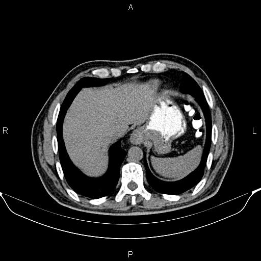 Cecal adenocarcinoma (Radiopaedia 85324-100916 Axial non-contrast 11).jpg