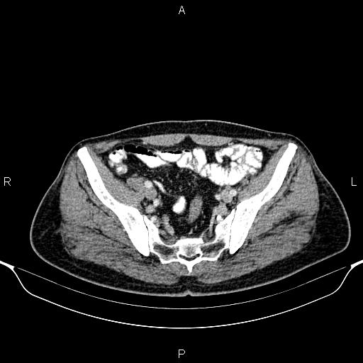 File:Cecal adenocarcinoma (Radiopaedia 85324-100916 B 79).jpg