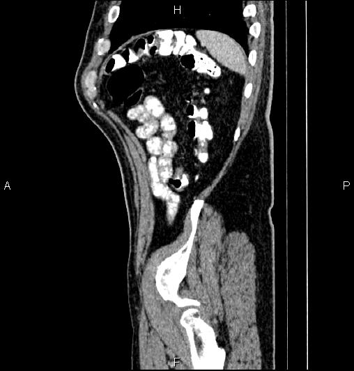 Cecal adenocarcinoma (Radiopaedia 85324-100916 E 81).jpg