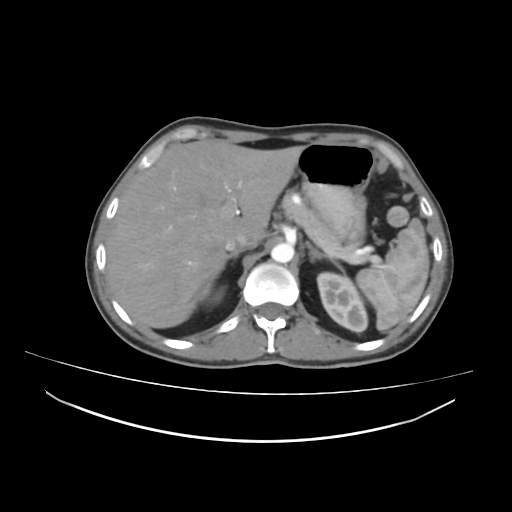 Cecal carcinoma with local lymphadenopathy (Radiopaedia 31428-32240 A 10).jpg