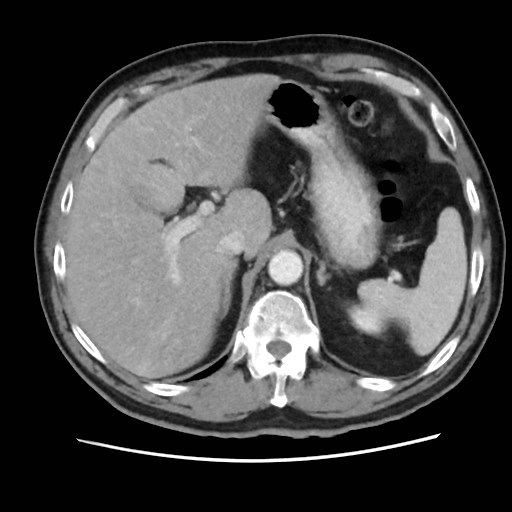 Cecal mass causing appendicitis (Radiopaedia 59207-66531 A 22).jpg