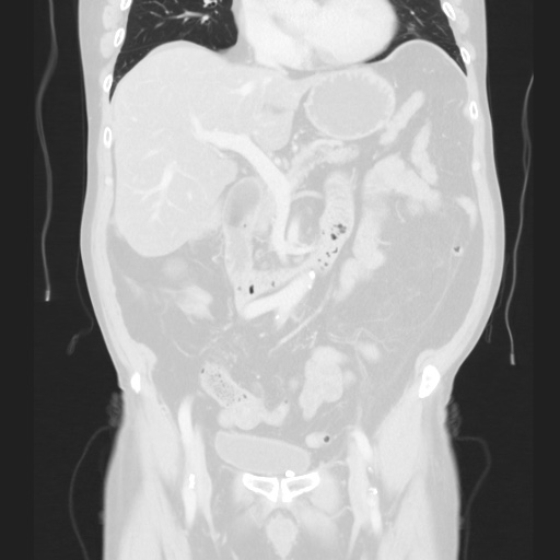 Cecal volvulus (Radiopaedia 75378-86620 Coronal lung window 68).jpg