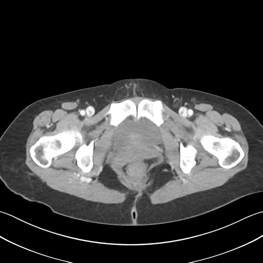 Cecum hernia through the foramen of Winslow (Radiopaedia 46634-51112 A 74).png