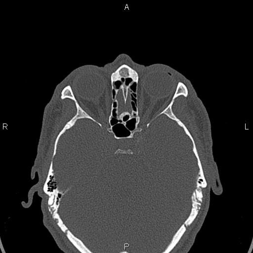 File:Central giant cell granuloma (Radiopaedia 83346-97761 Axial bone window 60).jpg