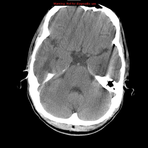 File:Central nervous system vasculitis (Radiopaedia 8410-9234 Axial non-contrast 8).jpg