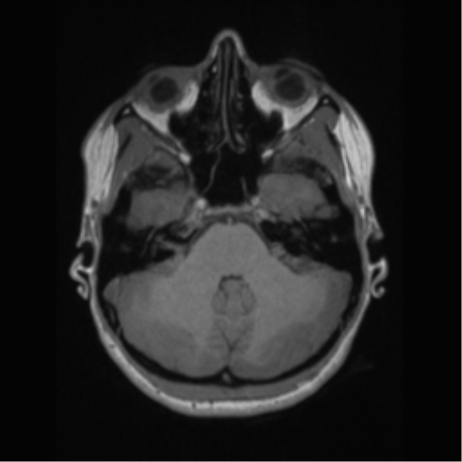 File:Central neurocytoma (Radiopaedia 37664-39557 Axial T1 17).png