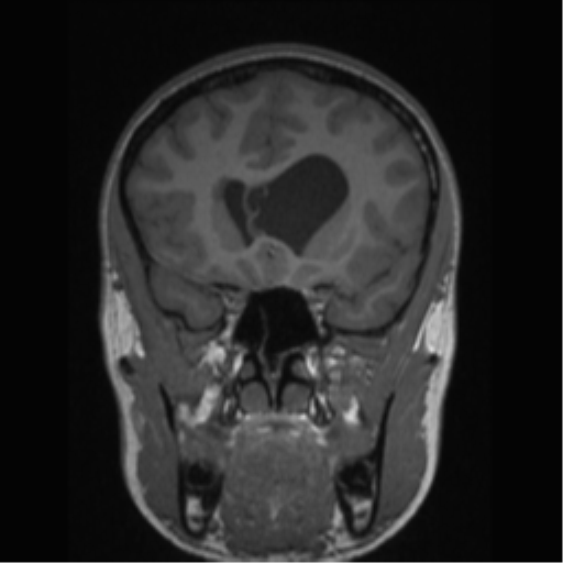 Central neurocytoma (Radiopaedia 37664-39557 Coronal T1 61).png