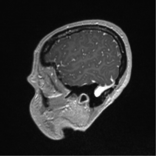 File:Central neurocytoma (Radiopaedia 37664-39557 Sagittal T1 C+ 81).png