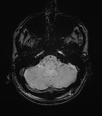 Central neurocytoma (Radiopaedia 71068-81303 Axial SWI 8).jpg