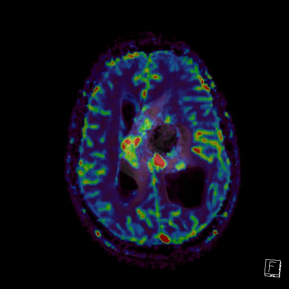 Central neurocytoma (Radiopaedia 84497-99872 Axial Perfusion 123).jpg