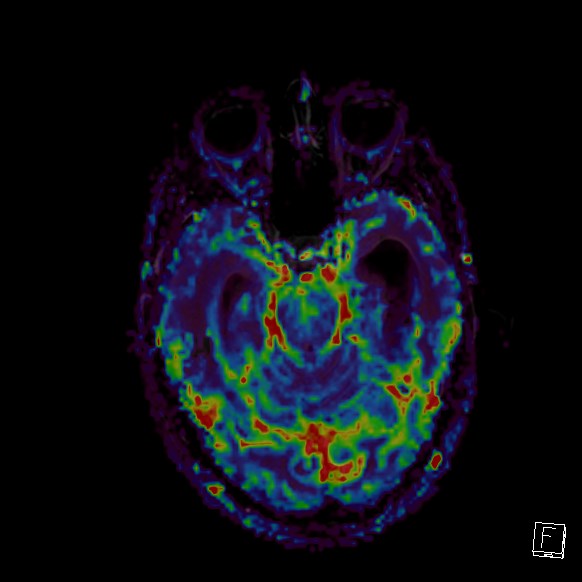 Central neurocytoma (Radiopaedia 84497-99872 Axial Perfusion 212).jpg
