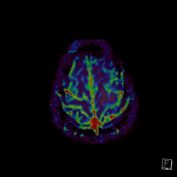 Central neurocytoma (Radiopaedia 84497-99872 Axial Perfusion 33).jpg