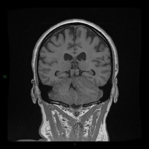 Cerebellar abscess (Radiopaedia 78135-90678 Coronal T1 C+ 103).jpg