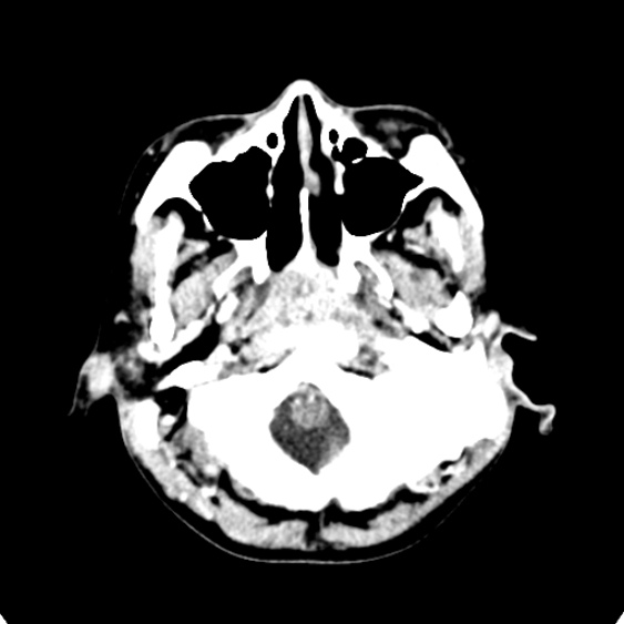 Cerebellar abscess secondary to mastoiditis (Radiopaedia 26284-26412 Axial C+ delayed 12).jpg