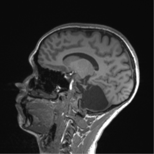 Cerebellar agenesis with hypoplastic pons (pontocerebellar hypoplasia) (Radiopaedia 57224-64138 Sagittal T1 40).png