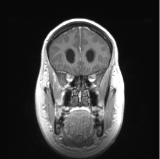 Cerebellar ependymoma complicated by post-operative subdural hematoma (Radiopaedia 83322-97736 Coronal T1 C+ 15).png