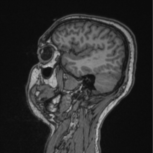 Cerebellar hemangioblastomas and pituitary adenoma (Radiopaedia 85490-101176 Sagittal T1 72).png