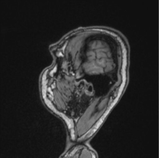Cerebellar hemangioblastomas and pituitary adenoma (Radiopaedia 85490-101176 Sagittal T1 82).png
